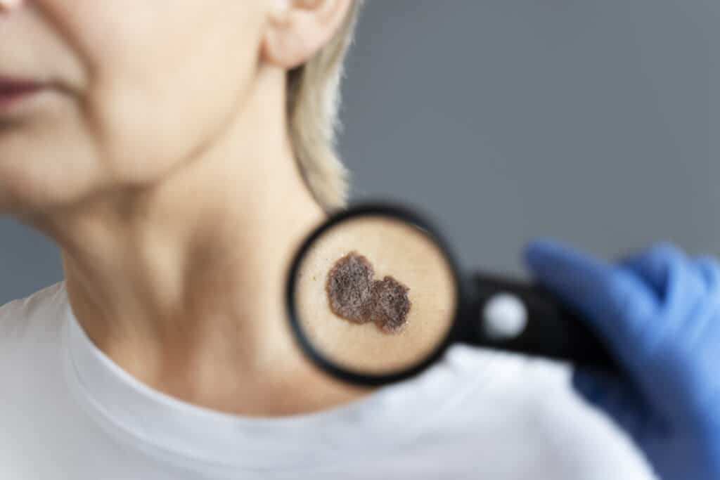 Cannabis-Derived Compound Shows Promise in Killing Melanoma Cells